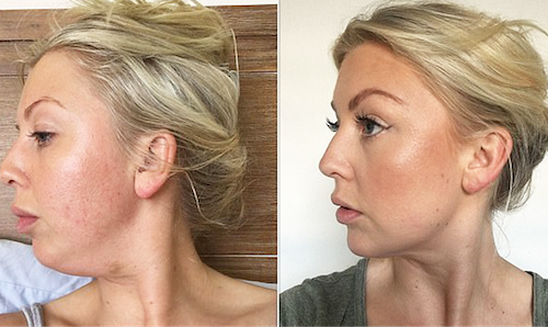 Double Chin Fat Dissolving Injections Before After Mississauga Oakville